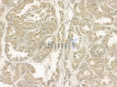 PIBF1 Antibody - DF7171 at 1/100 staining human renal cell carcinoma by IHC-P.