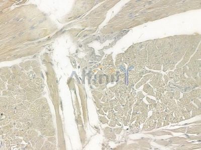TRAF7 Antibody - DF7182 at 1/100 staining human tongue carcinoma by IHC-P.