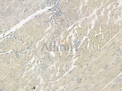 TRIM63 Antibody - DF7187 at 1/100 staining human tongue carcinoma by IHC-P.