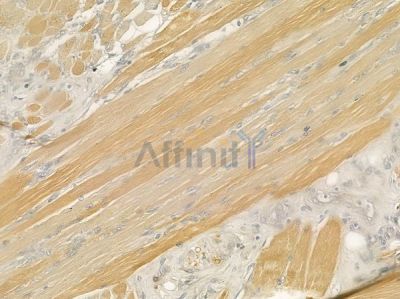 SCTR Antibody - DF7201 at 1/100 staining human tongue carcinoma by IHC-P.