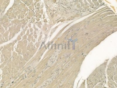 NTF4 Antibody - DF7236 at 1/100 staining human tongue carcinoma by IHC-P.