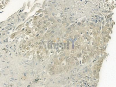 PELP1 Antibody - DF7242 at 1/100 staining human lung squamous cell carcinoma by IHC-P.