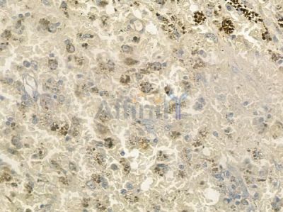 SETD2 Antibody - DF7246 at 1/100 staining human melanoma by IHC-P.