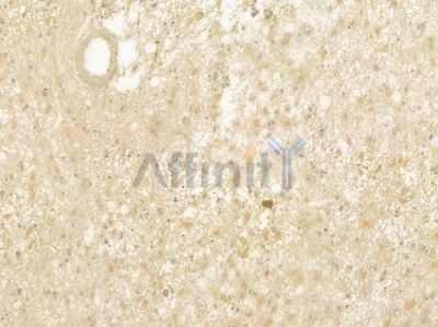 CHRNB1 Antibody - DF7257 at 1/100 staining human astrocytoma by IHC-P.