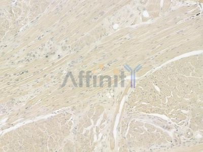 CHRNA1 Antibody - DF7264 at 1/100 staining human tongue carcinoma by IHC-P.