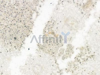 POLD1 Antibody - DF7274 at 1/100 staining human glioblastoma by IHC-P.