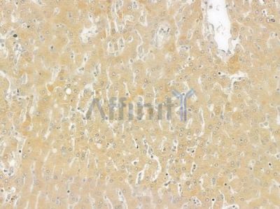 SGCE Antibody - DF7279 at 1/100 staining human hepatocellular carcinoma by IHC-P.