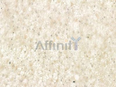 GHRH Antibody - DF7285 at 1/100 staining human astrocytoma by IHC-P.