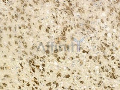 HDGF Antibody - DF7289 at 1/100 staining human melanoma by IHC-P.