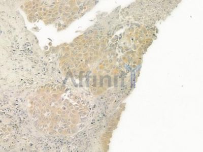 HFE2 Antibody - DF7290 at 1/100 staining human lung squamous cell carcinoma by IHC-P.