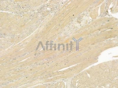 VAPB Antibody - DF7303 at 1/100 staining human tongue carcinoma by IHC-P.