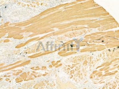 AZGP1 Antibody - DF7304 at 1/100 staining human tongue carcinoma by IHC-P.