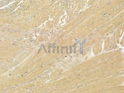 DBI Antibody - DF7307 at 1/100 staining human tongue carcinoma by IHC-P.