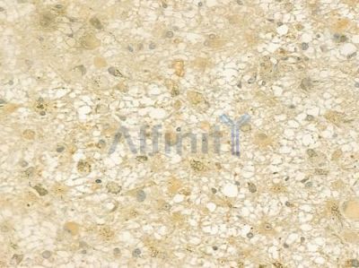 AP2A2 Antibody - DF7319 at 1/100 staining human astrocytoma by IHC-P.
