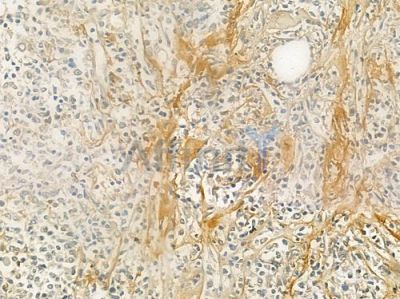 CYB5 Antibody - DF7321 at 1/100 staining human Hodgkin lymphoma by IHC-P.
