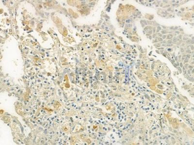 eEF2K Antibody - DF7323 at 1/100 staining human lung squamous cell carcinoma by IHC-P.