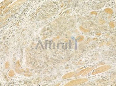 TFDP1 Antibody - DF7337 at 1/100 staining human tongue carcinoma by IHC-P.