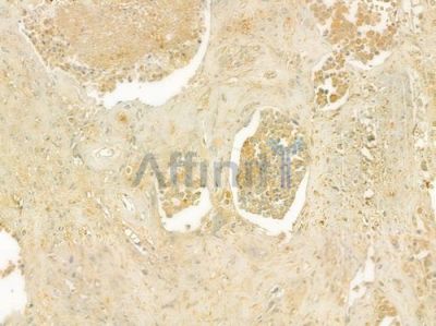 KIF2C Antibody - DF7348 at 1/100 staining human prostate carcinoma by IHC-P.