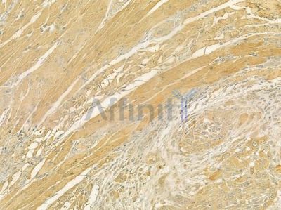 Myoglobin Antibody - DF7358 at 1/100 staining human tongue carcinoma by IHC-P.