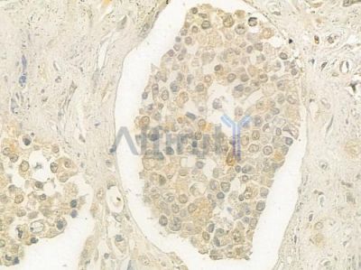 PRPF3 Antibody - DF7364 at 1/100 staining human prostate carcinoma by IHC-P.