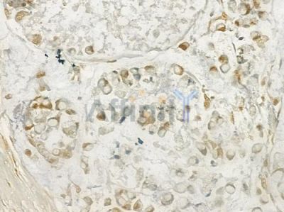 IL27A Antibody - DF7377 at 1/100 staining human gastric carcinoma by IHC-P.