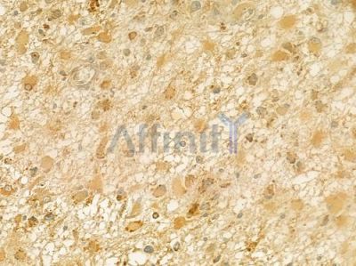 PKP2 Antibody - DF7385 at 1/100 staining human thyroid carcinoma by IHC-P.