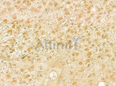 KLC1 Antibody - DF7392 at 1/100 staining human astrocytoma by IHC-P.