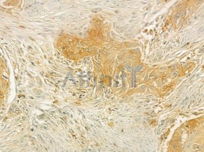 PSMF1 Antibody - DF7394 at 1/100 staining human tongue carcinoma by IHC-P.