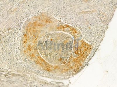 SH2B1 Antibody - DF7404 at 1/100 staining human tongue carcinoma by IHC-P.