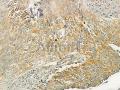 LSP1 Antibody - DF7420 at 1/100 staining human cervical carcinoma by IHC-P.