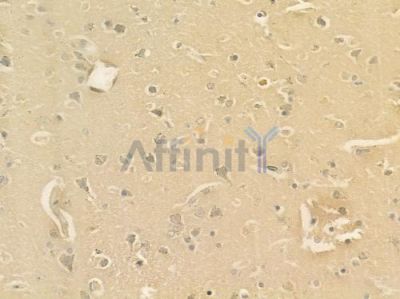 5HT3A receptor Antibody - DF7437 at 1/100 staining human glioblastoma by IHC-P.
