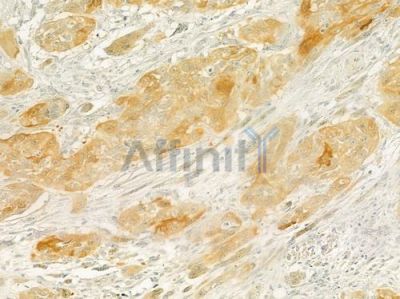 prouty 4 Antibody - DF7509 at 1/100 staining human tongue carcinoma by IHC-P.