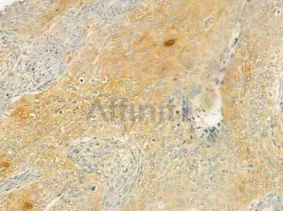prouty 4 Antibody - DF7509 at 1/100 staining human cervical carcinoma by IHC-P.