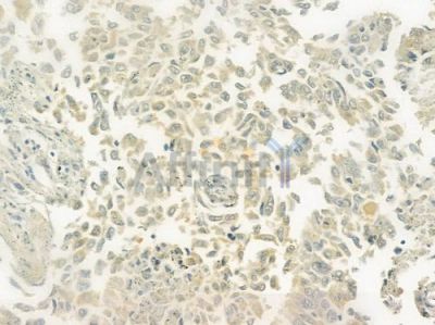 TRPM2 Antibody - DF7533 at 1/100 staining human lung squamous cell carcinoma by IHC-P.