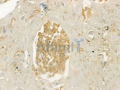 MFN1 Antibody - DF7543 at 1/100 staining human prostate carcinoma by IHC-P.