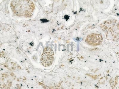 MFN1 Antibody - DF7543 at 1/100 staining human gastric carcinoma by IHC-P.