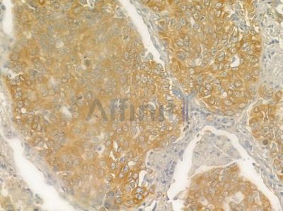 MFN1 Antibody - DF7543 at 1/100 staining human lung squamous cell carcinoma by IHC-P.