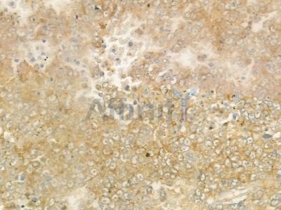MFN1 Antibody - DF7543 at 1/100 staining human melanoma by IHC-P.