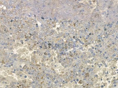 Phospho-ULK1 (Ser556) Antibody - DF7587 at 1/100 staining human melanoma by IHC-P.