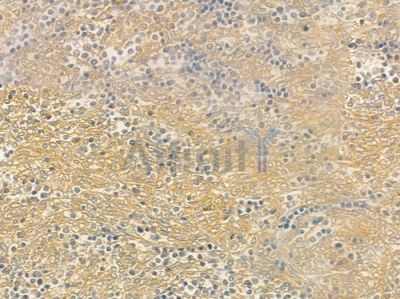 Phospho-PKA beta (Thr197)[Thr198] Antibody - DF7589 at 1/100 staining human thymoma by IHC-P.