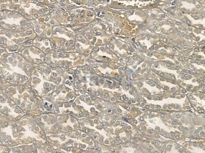 Phospho-HER3/ErbB3 (Tyr1289) Antibody - DF7597 at 1/100 staining human renal cell carcinoma by IHC-P.