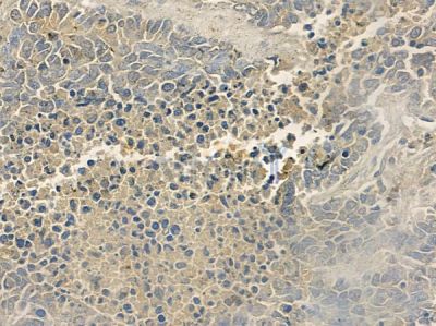 Phospho-HER3/ErbB3 (Tyr1289) Antibody - DF7597 at 1/100 staining human large cell lung carcinoma by IHC-P.