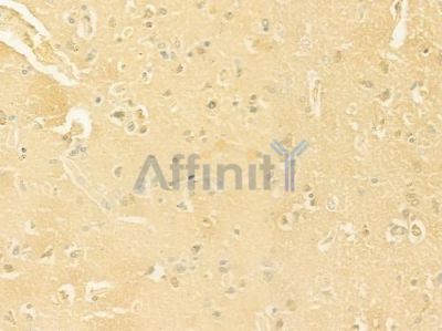 NCR1 Antibody - DF7599 at 1/100 staining human glioblastoma by IHC-P.