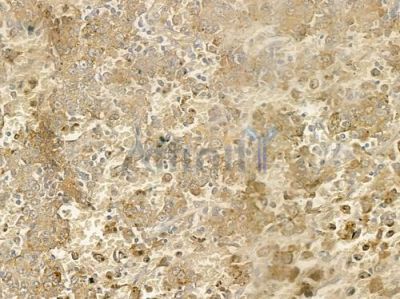 Caspase 4/11 Antibody - DF7609 at 1/100 staining human melanoma by IHC-P.
