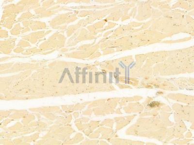 IL15 Antibody - DF7654 at 1/100 staining human tongue carcinoma by IHC-P.