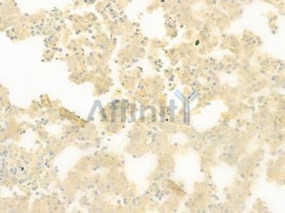 Amylin Antibody - DF7715 at 1/100 staining human melanoma by IHC-P.