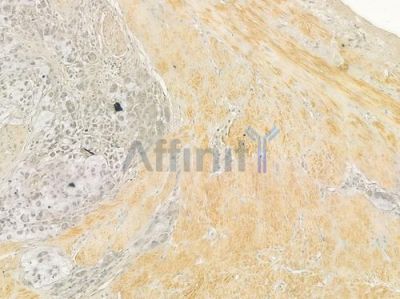 UCP1 Antibody - DF7720 at 1/100 staining human gastric carcinoma by IHC-P.
