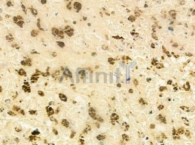 tbx21 Antibody - DF7759 at 1/100 staining human melanoma by IHC-P.