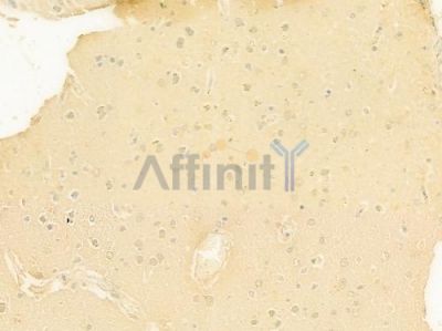 SIAH2 Antibody - DF7767 at 1/100 staining human glioblastoma by IHC-P.