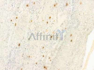 CTNNBL1 Antibody - DF7835 at 1/100 staining human cervical carcinoma by IHC-P.